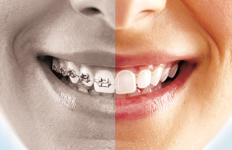 Image showing the difference between braces and 牙速齐's clear aligners.